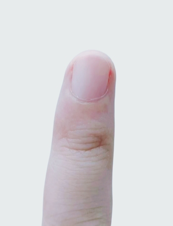 指甲出現(xiàn)一條黑線 別不當(dāng)回事！可能是癌變